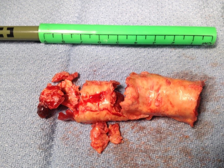 Fat in the Artery: You Will Believe It Only After You See It